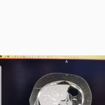 Image from Jayne's Baby Bank (main page), 1 Sep 2025: Ct of the tumor in my womb. Hoping it has shrunk . This was taken in 2015 and shelved. I found the ct scan missing from my medical records i